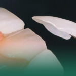 كل ما تود معرفته عن عدسات الأسنان التجميلية أنواعها، فوائدها، وكيفية اختيار الأفضل لابتسامتك