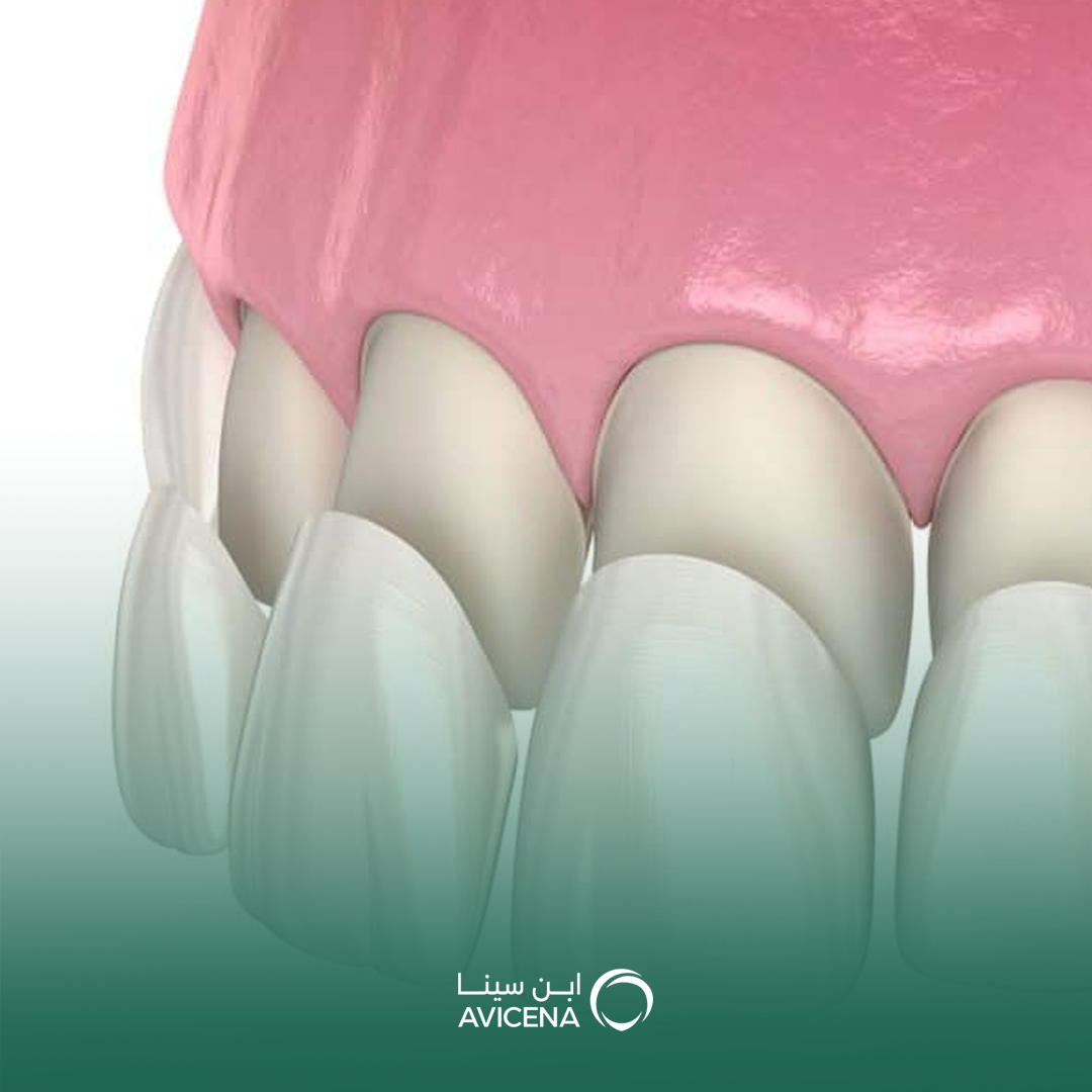 عدسات الأسنان التجميلية