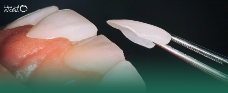 كل ما تود معرفته عن عدسات الأسنان التجميلية أنواعها، فوائدها، وكيفية اختيار الأفضل لابتسامتك