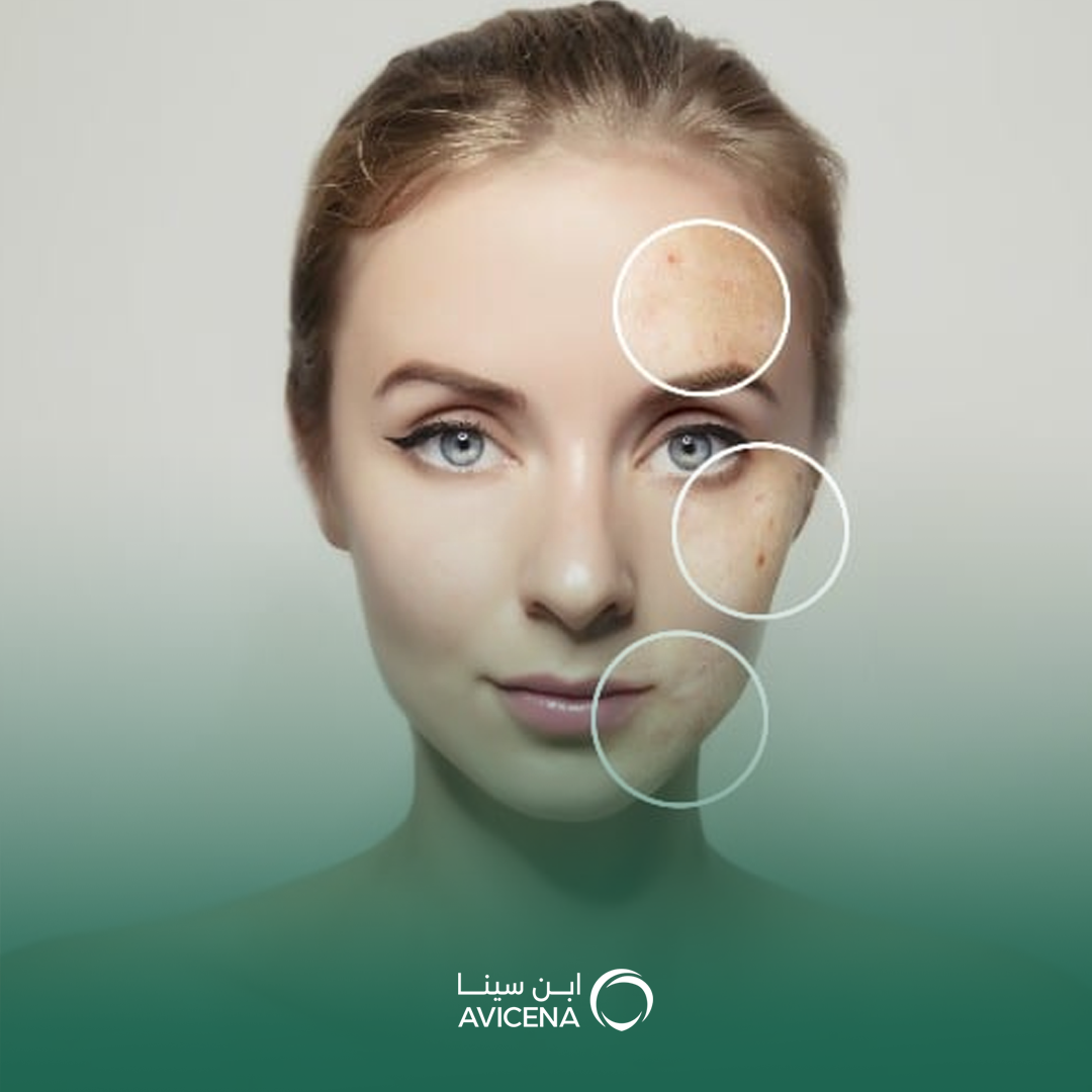 علاج التصبغات والبقع