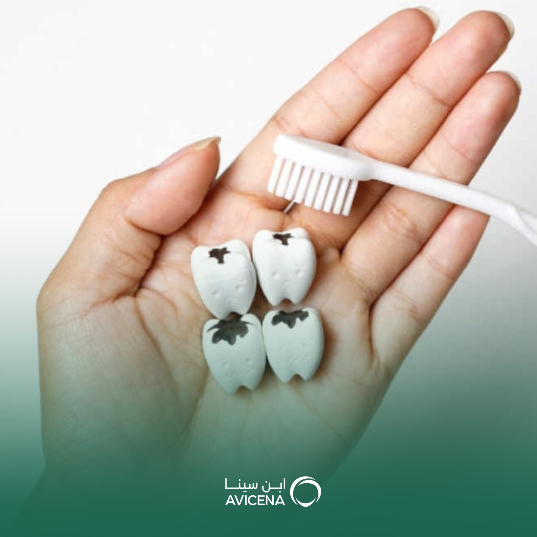 علاج تسوس الأسنان