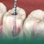 كل ما تريد معرفته عن مراحل علاج عصب الأسنان والتعافي بعد الجلسة