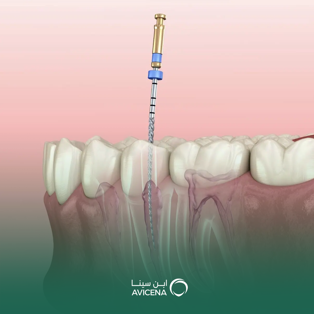 علاج عصب الاسنان