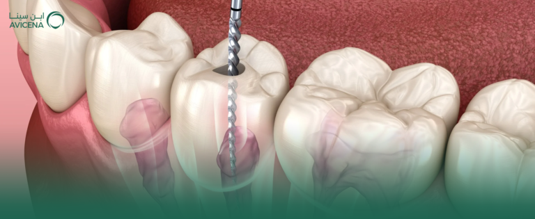 كل ما تريد معرفته عن مراحل علاج عصب الأسنان والتعافي بعد الجلسة